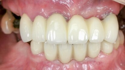 Maxillary full-arch implant-supported rehabilitation with a digital workflow: Two-year follow-up