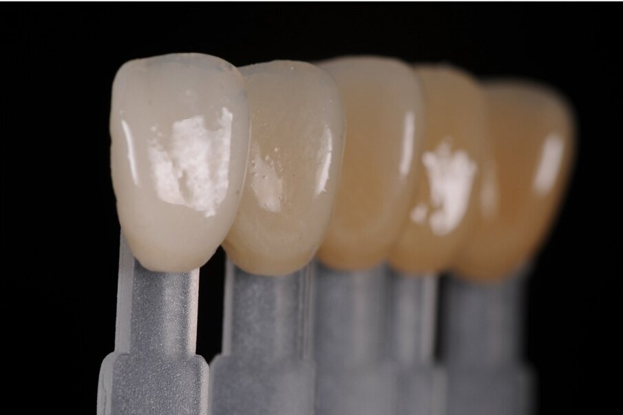 Fig. 3: Two-layer personalised shade guide. This makes composite layering more predictable, but has limitations and some problems.