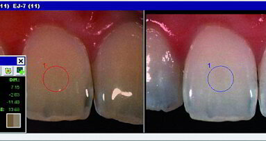 Blanchiment dentaire : une approche conservatrice