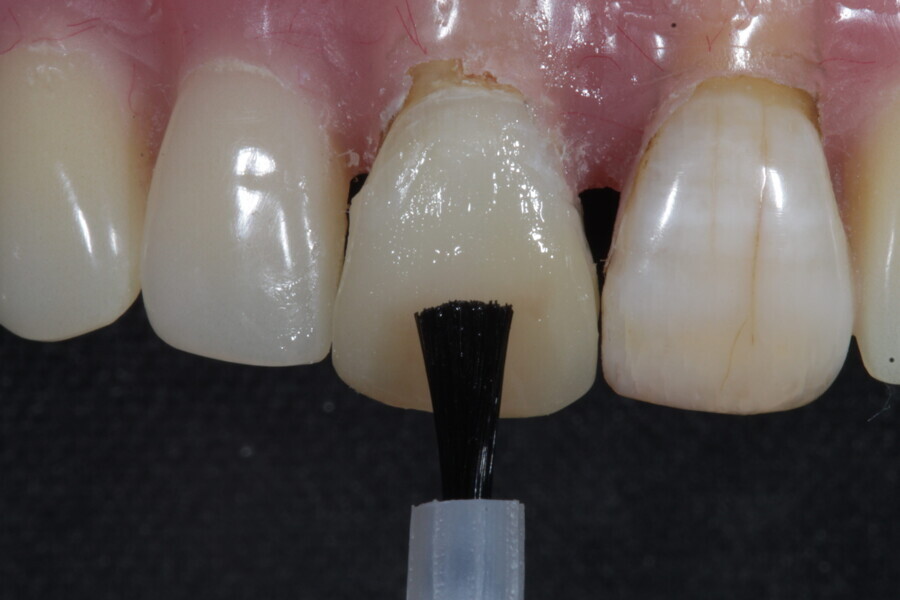 Fig. 16: A layer of supra-nano hybrid body (A20) in Shade A3.5 is applied (Estelite).