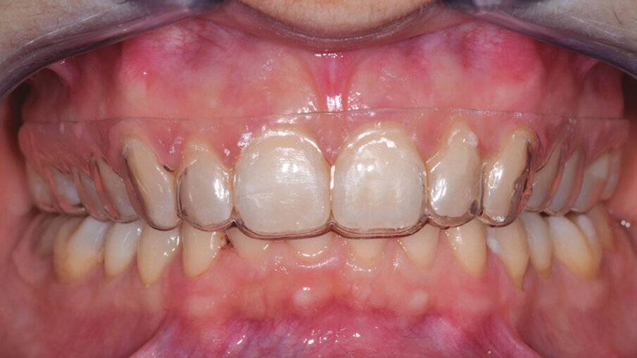 Figg. 11a, 11b_Foto contenzione con retainer e mascherina rigida.