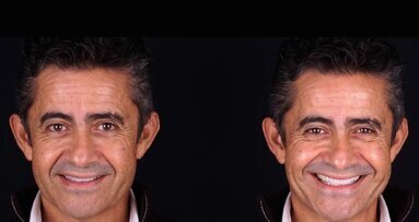 Colocación de restauraciones cerámicas adhesivas en la zona estética (2)