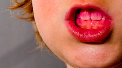 Il grafene rallenta la carie e la malattia parodontale