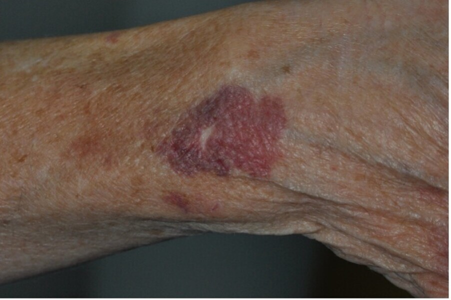 Fig. 5 : Manifestation cutanée idiopathique survenu chez cette patiente ayant bénéficié d’implant 4–5 ans auparavant. La patiente a commencé par perdre certains implants sans manifestation infectieuse majeure. Les signes dermatologiques se sont aggravés lors de la mise en place des piliers prothétiques.