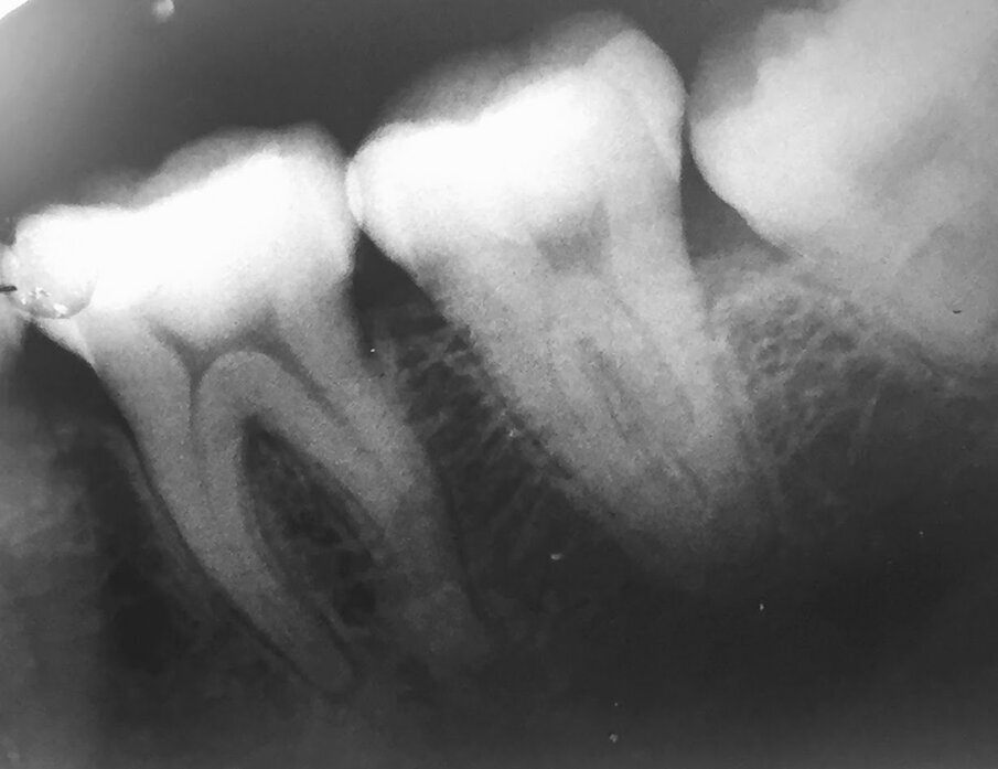 Pre operative radiograph
