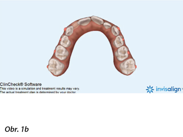 Moláry jsou částečně expandované. Špičáky a všechny laterální zuby expandují simultánně. Vyrovnání řezáků probíhá od začátku léčby (b)