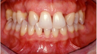 Il ruolo dell’ortodonzia nei trattamenti interdisciplinari