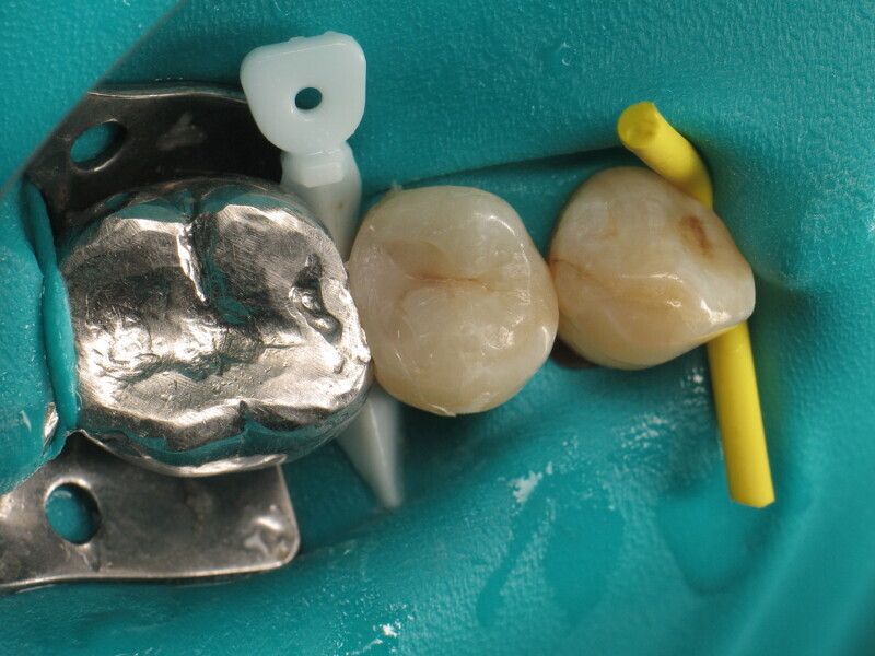 Fig. 19 : Retrait de la matrice proximale.