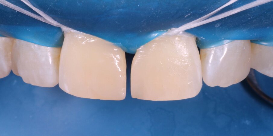 Fig 6. Both Front wings formed