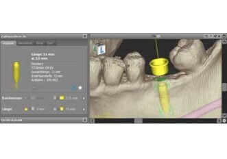 Neodent implant library now available in coDiagnostiX Guided Surgery planning software from Dental Wings