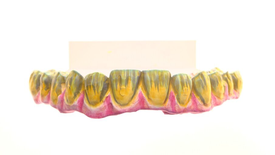 Full-arch rehabilitation with lithium disilicate secondary crowns_5d