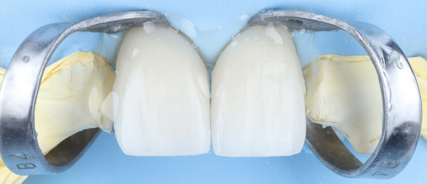 Fig. 19c: Application of glycerine gel at the restoration margins to prevent oxygen inhibition during light polymerisation.