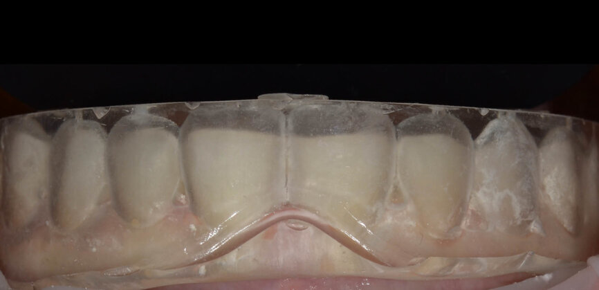 Fig. 3: A silicone mould was used for the flowable injection technique to restore the teeth with flowable composite. The silicone injection mould had injection channels prepared and was placed to check for proper fit. 