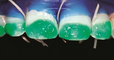 Infiltratie van fluorosevlekken ter bevordering van weefselconservering