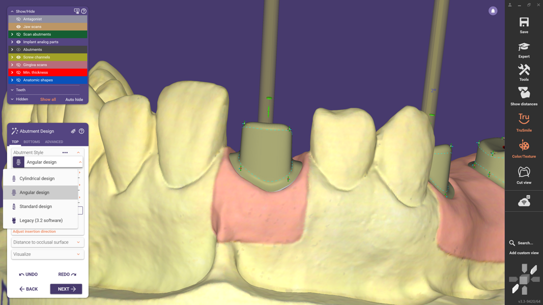 Fig. 6: When selecting the abutment style, users can choose between cylindrical, angular and standard designs or revert to the legacy workflow to maintain established working routines.