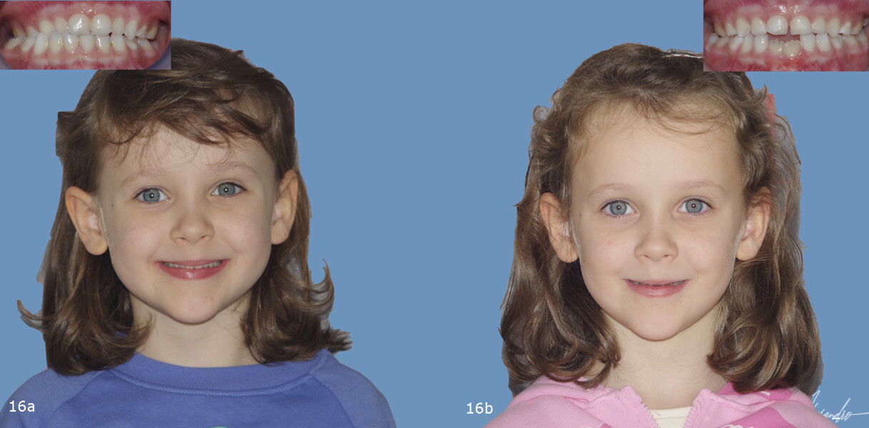 Figs. 16a &b: Facial comparison before treatment showing harmonisation of proportions.