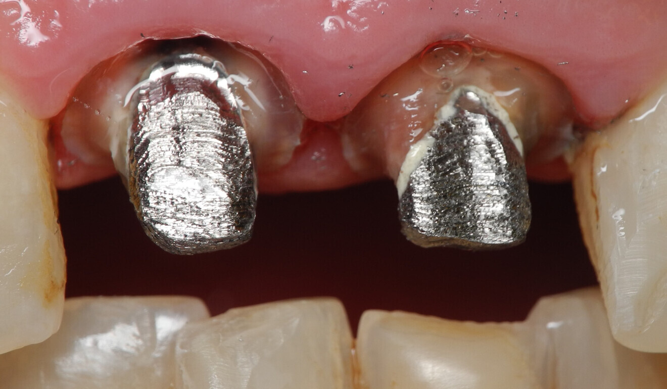 Fig. 2: Situation after removal of the existing restorations.