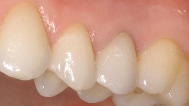 Computer-aided crown design – Fabrication of CAD/CAM crowns chairside