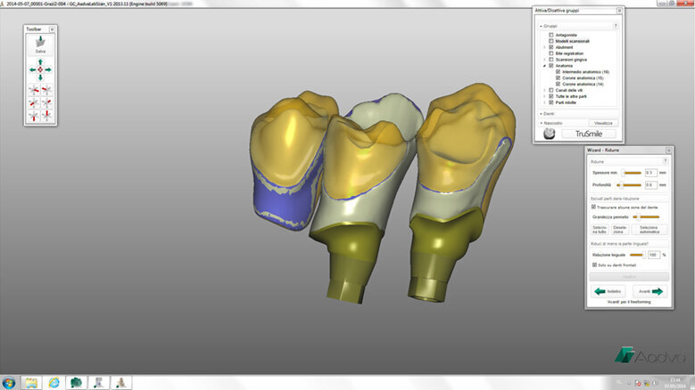 Aadva Lab Scan – vysoká  přesnost pro dokonalé náhrady