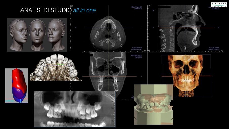 Fig. 2 - Esempio di records digitali di comune impiego. L’utilizzo integrato di dati 3D, provenienti da fonti differenti (foto digitali, scanner intraorali, scanner facciale, radiografie digitali, Tc Cone Beam, etc.), permette valutazioni diagnostiche particolarmente accurate, simulazioni attendibili degli obbiettivi terapeutici, misurazioni precise di tutte le componenti anatomiche, sovrapposizioni dei vari record per l’evidenziazione delle modificazioni ottenute (in corso di trattamento – alla fine del trattamento – follow up a distanza). 
