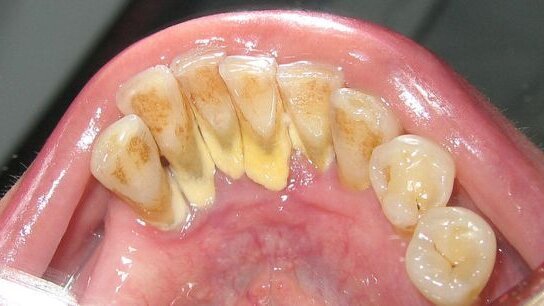 Kamień nazębny – problem poważny i wciąż ignorowany