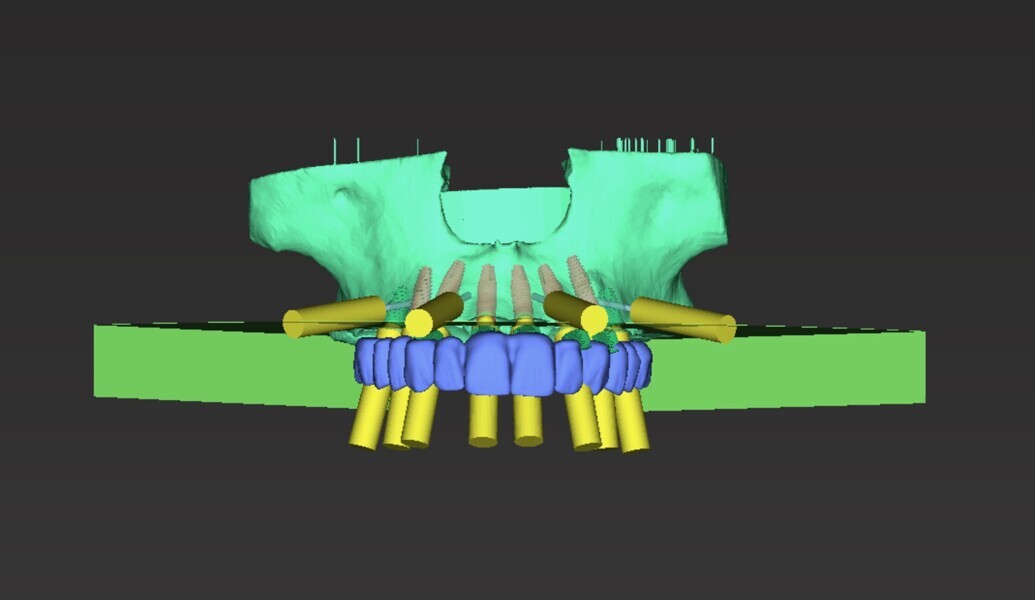 Fig. 14: Maxillary surgical treatment planning with the maxillary prosthesis using coDiagnostiX.
