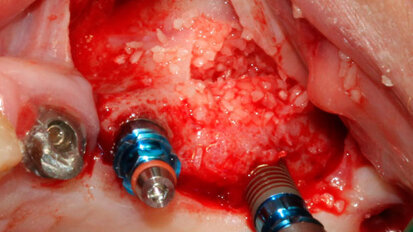 Rialzo di seno mascellare per via laterale  con l’utilizzo di PRGF®-Endoret® e di Hypro-Oss®