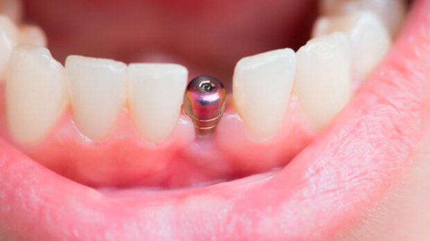 Un nuovo rivestimento potrebbe eliminare il rischio di insuccessi implantari