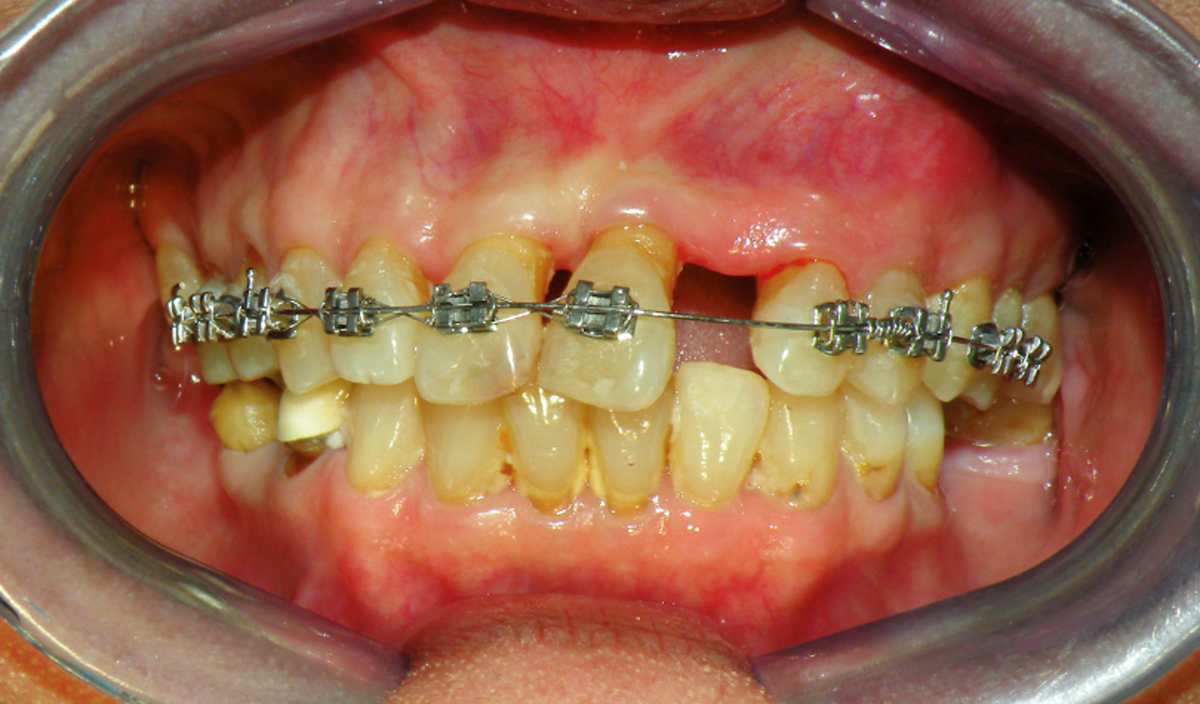  Fig. 5a: Sliding on 016 stainless steel with pushcoil, 21 and 22 mesialized creating space  between 22 and 23. Both laterals have more vertical bone support to protect and re duce unwanted tipping of centrals during retraction.