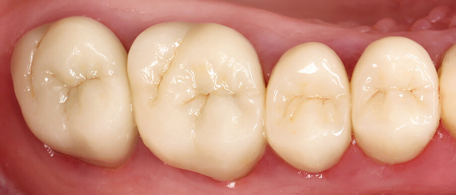 Fig. 10: Check-up of the crowns in 2012