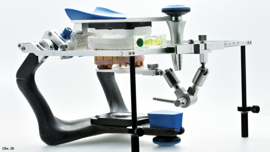 Pomocí obličejového oblouku bylo získáno značné množství dat, která byla přenesena do artikulátoru Artex CR.