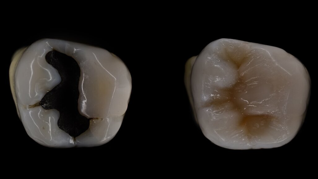 L'interdiction des amalgames avance à grands pas... Quelles sont les alternatives ?