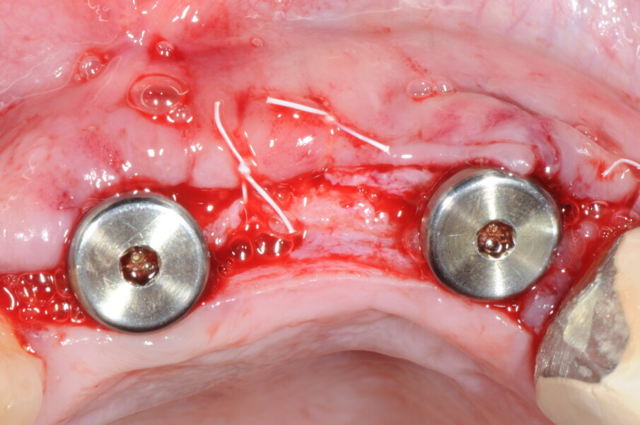Fig. 21 - Innesto di Derma, L-PRF e posizionamento delle viti di guarigione.