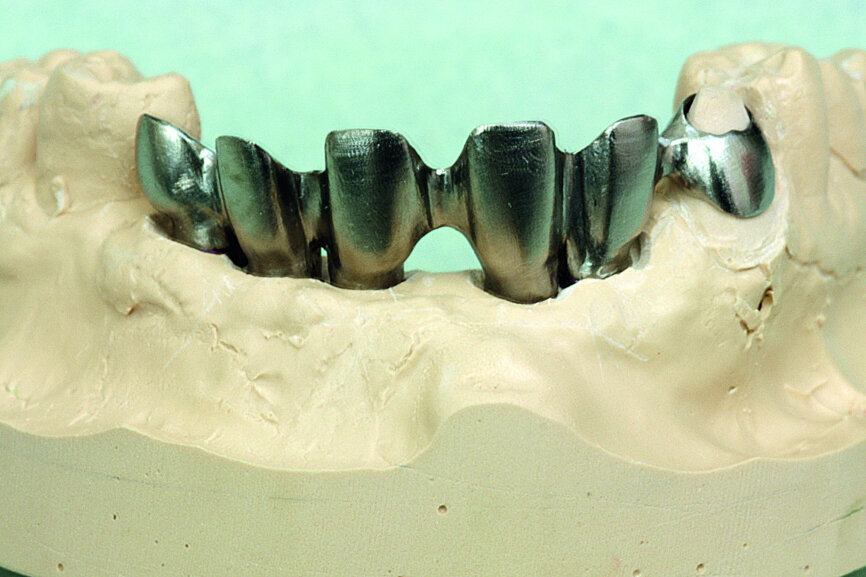 Fig. 26: Testing of the titanium framework on the working model and verifi cation of stability.