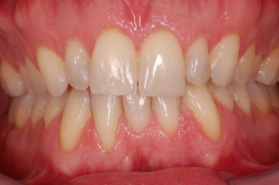 Figg. 45-50_Fotografie intraorali frontali in sequenza che illustrano il progressivo livellamento e allineamento e il raddrizzamento dell’incisivo laterale mandibolare destro.