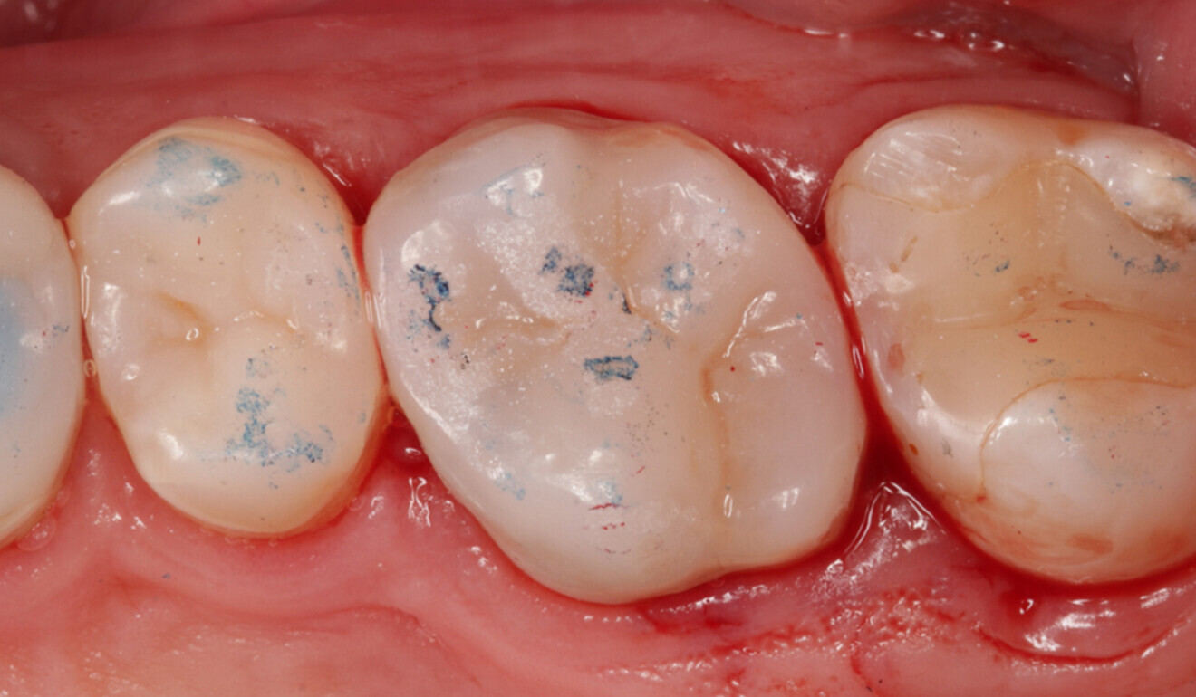 Fig. 18: Occlusal adjustment. Contact points recorded with articulating paper (100 μm). (Image: Kuraray Noritake Dental)