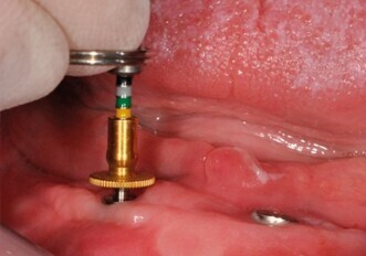 Misuratore universale di bordo gengivale