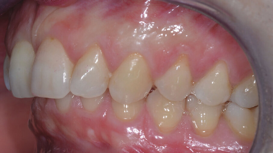 Figg. 4d-4f_Foto intraorali di inizio trattamento.