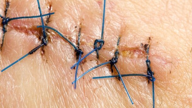 Nici chirurgiczne z czujnikami ułatwią gojenie ran po operacjach