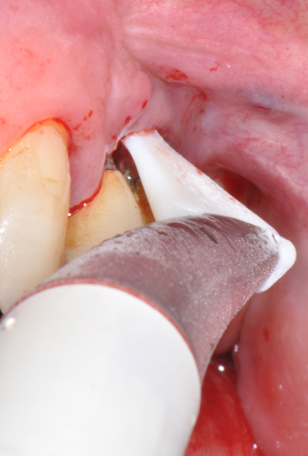 Fig.16: Case 2. Subgingival decontamination with erythritol powder and sub-gingival tip.