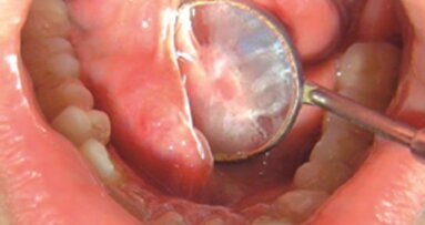 Leczenie zachowawcze dużych kamieni gruczołów ślinowych w śliniance podżuchwowej