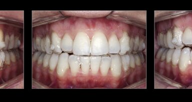 Estética y blanqueamiento dental en la era digital  (Capítulo 16)