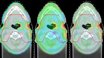 Punktgenaue Strahlentherapie für Krebspatienten
