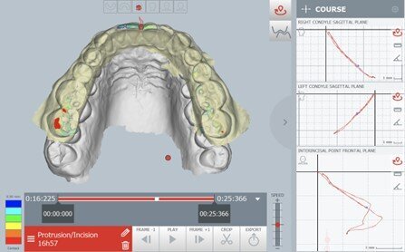 Fig. 7_I contatti occlusali registrati durante il movimento di protrusione mandibolare evidenziano contatti anomali a livello dei secondi molari inferiori. Il punto rosso indica un contatto anomalo durante 
la protrusiva.