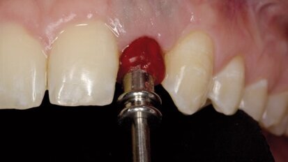 Zastosowanie techniki CAD/CAM do zindywidualizowania łącznika standardowego