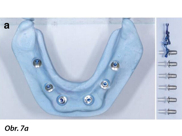 CAD/CAM model s prefabrikovanými titanovými abutmenty (a), CAD/CAM chromkobaltová základní konstrukce (b) a provizorní fixní náhrada fazetovaná kompozitem (c, d) před připevněním na abutmenty.