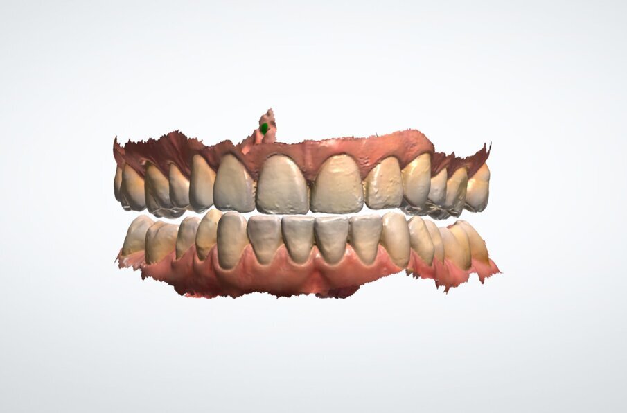 Obr. 2: Digitalizovaný intraorální sken.