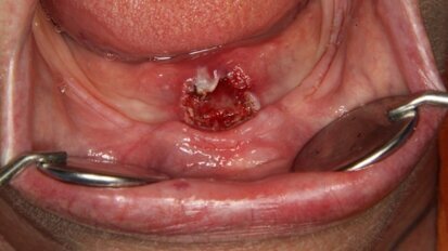 Laser diodowy – nowoczesne narzędzie w chirurgii tkanek miękkich jamy ustnej