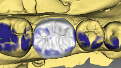 Figs. 3a & 3b. Diseño de la corona con el software (inLab) y prueba de la corona antes de la cocción de cristalización (IPS e.max CAD).