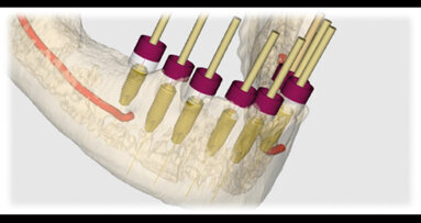 Planificación y Tratamiento mediante Cirugía Guiada Asistida por Ordenador